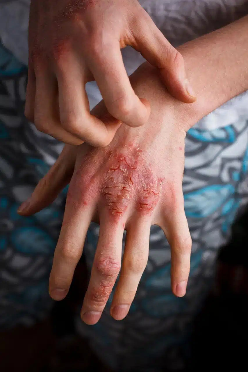 Why Cleaning Your Hands with Eczema Can Be So Painful (And What You Can Do About It)
